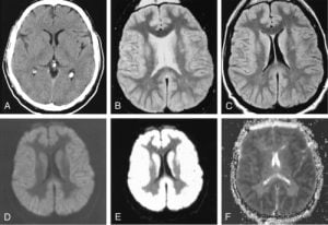 Anoxic Brain Injury Causes Symptoms Prognosis Vanguard Attorneys